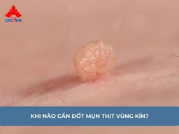 [Giải đáp] Cách chữa mụn thịt ở vùng kín tại nhà? Khi nào cần đốt?