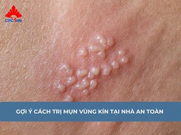 Gợi ý cách trị mụn vùng kín tại nhà an toàn, hiệu quả