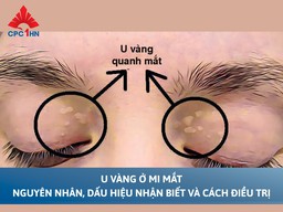 U vàng ở mi mắt: Nguyên nhân, dấu hiệu nhận biết và cách điều trị