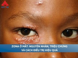 Zona ở mắt: Nguyên nhân, triệu chứng và cách điều trị hiệu quả